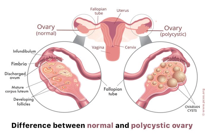 Diagram showing the difference between normal and polycystic ovaries (https://u.osu.edu/pcospathocasestudy/pathophysiology/).